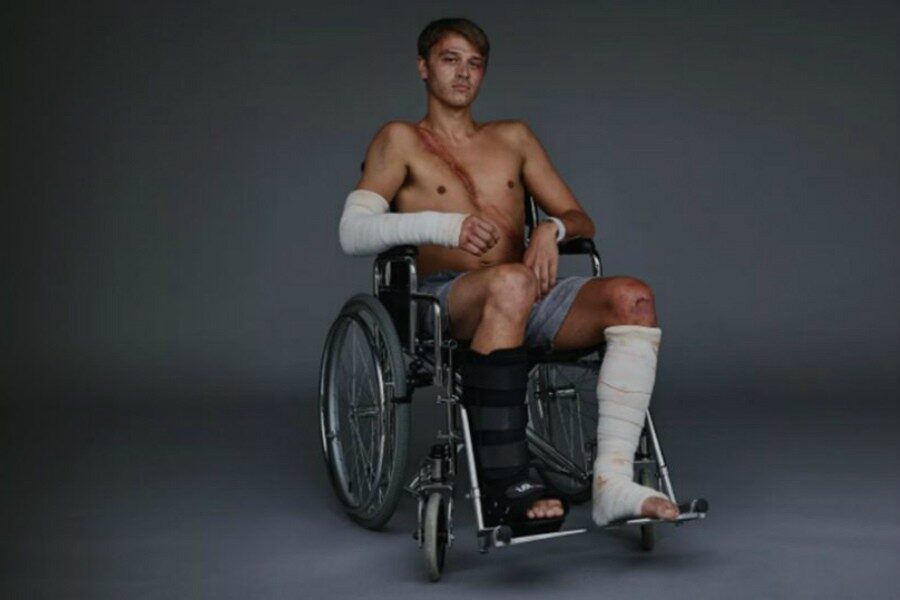 Además de las dos piernas, también se rompió un brazo y sufrió daños en varios órganos principales.